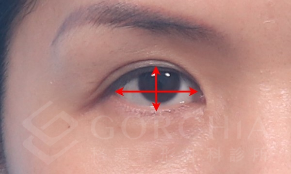 開眼尾手術-眼睛太圓，讓眼睛的左右長度適度的大於上下的幅度